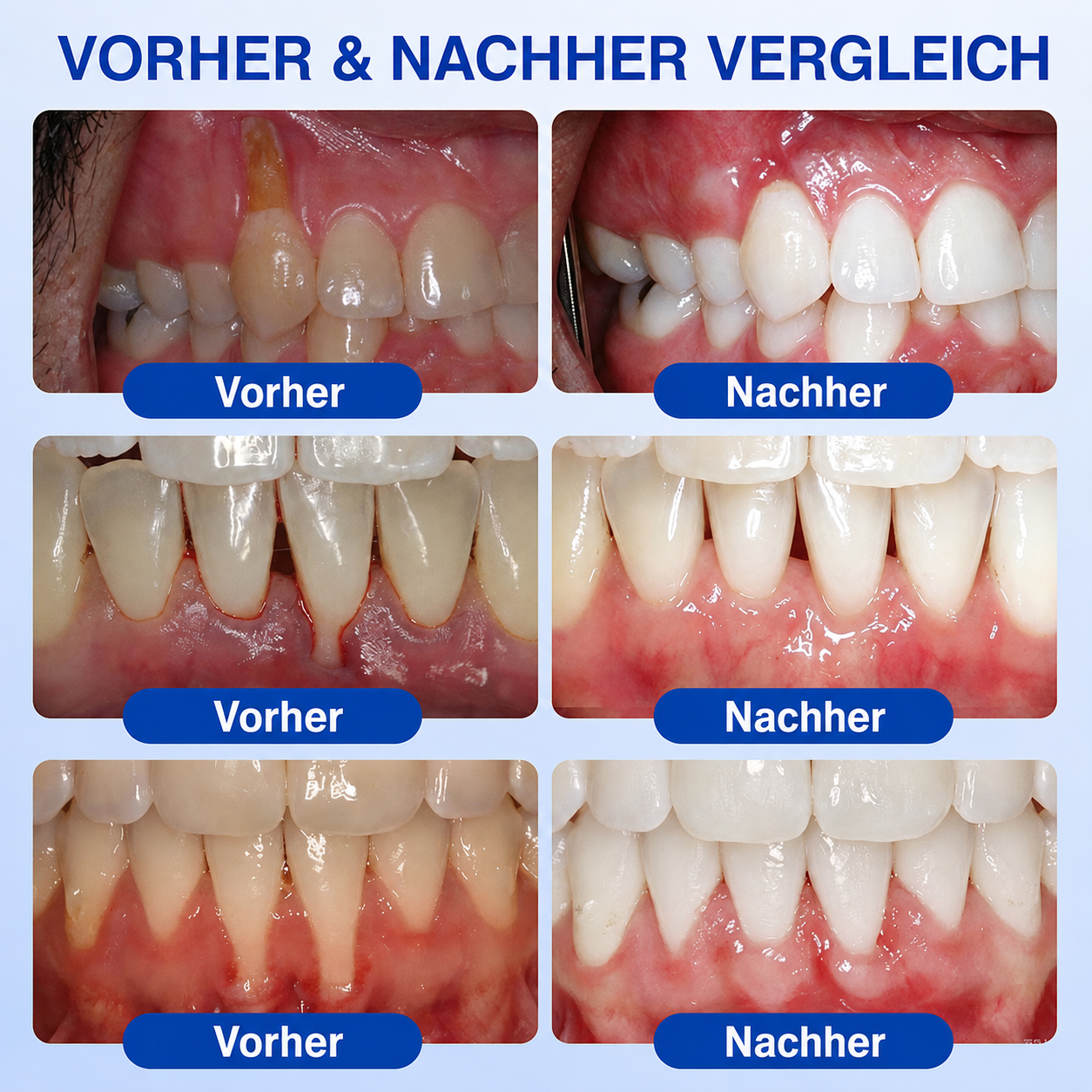 🦷 Healrize® GumRevive Gel zur Regeneration des Zahnhalteapparats (bei Zahnfleischbluten, Zahnfleischrückgang und lockeren Zähnen)