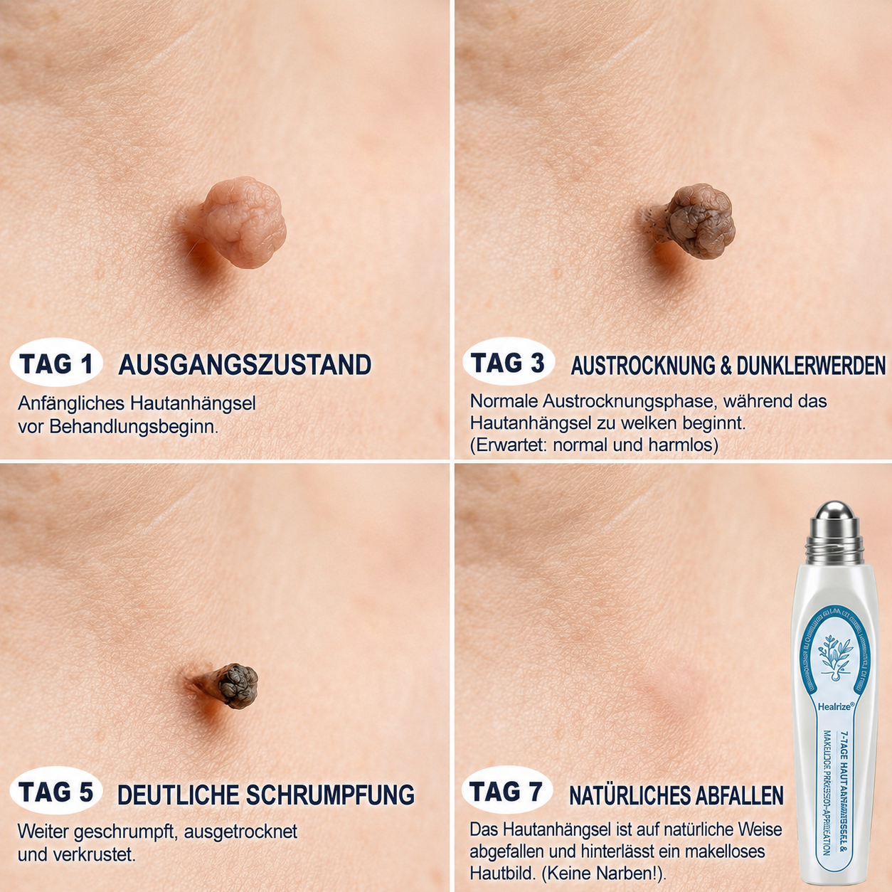 Healrize® 7-Tage Hautmal- & Flecken-Entferner 🍇(Schmerzfrei, Narbenfrei mit Rollball-Applikator)🍇